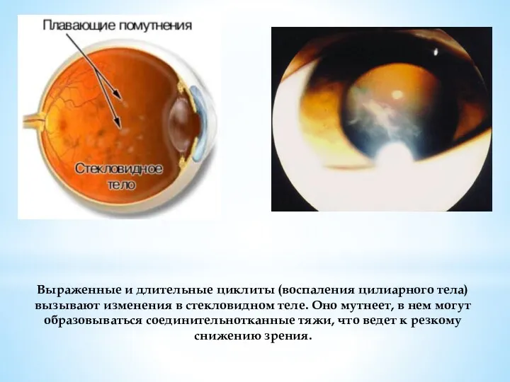Выраженные и длительные циклиты (воспаления цилиарного тела) вызывают изменения в