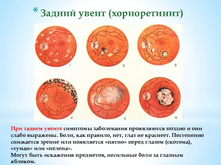 При заднем увеите симптомы заболевания проявляются поздно и они слабо