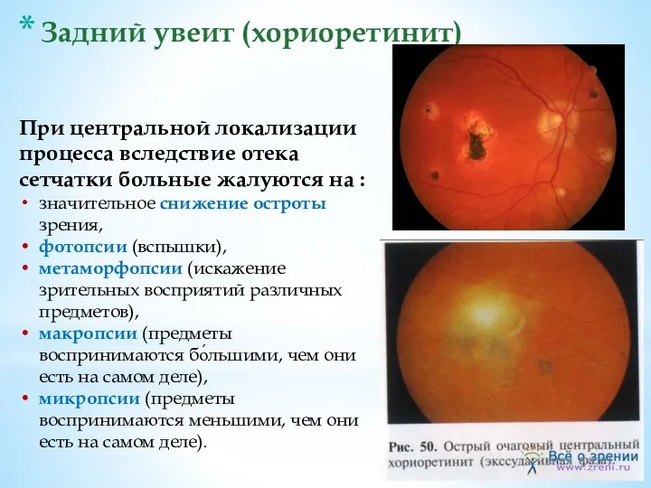 Задний увеит (хориоретинит) При центральной локализации процесса вследствие отека сетчатки