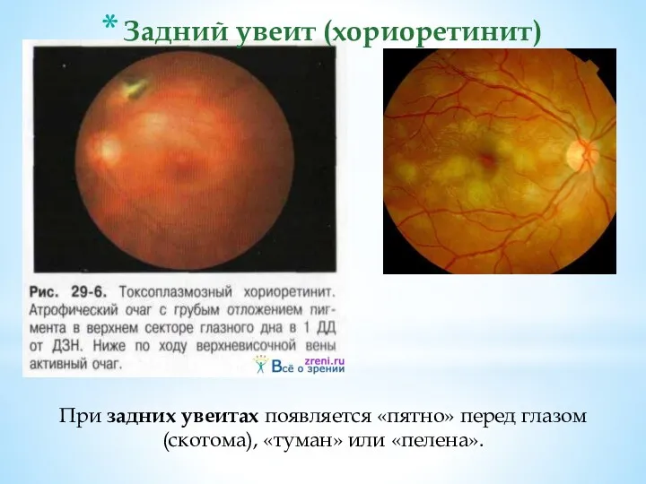 При задних увеитах появляется «пятно» перед глазом (скотома), «туман» или «пелена». Задний увеит (хориоретинит)