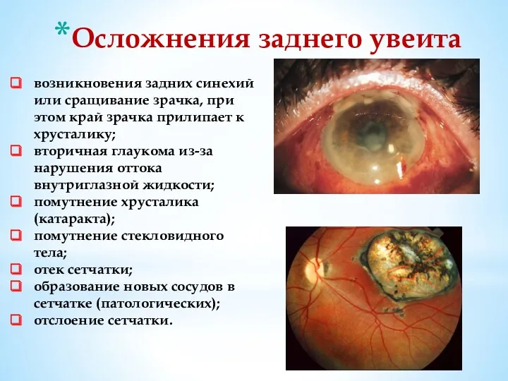 Осложнения заднего увеита возникновения задних синехий или сращивание зрачка, при