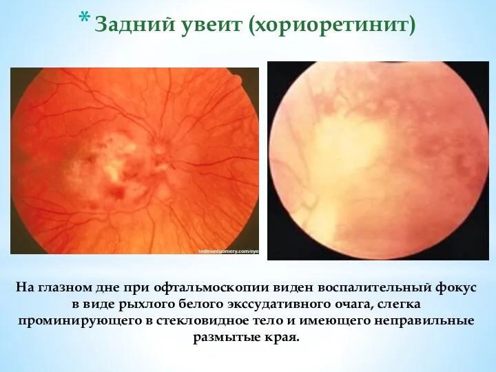 На глазном дне при офтальмоскопии виден воспалительный фокус в виде