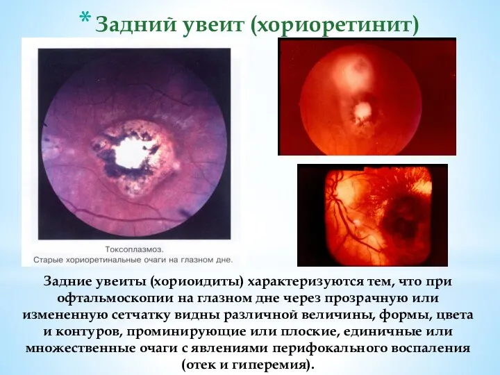 Задний увеит (хориоретинит) Задние увеиты (хориоидиты) характеризуются тем, что при