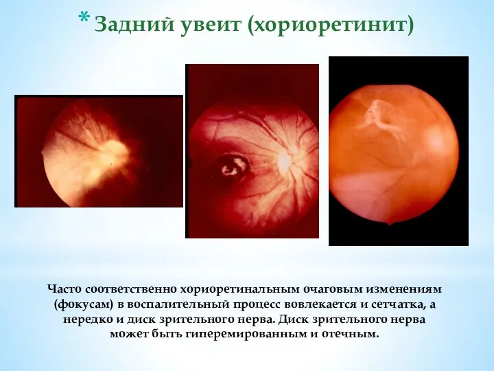 Часто соответственно хориоретинальным очаговым изменениям (фокусам) в воспалительный процесс вовлекается