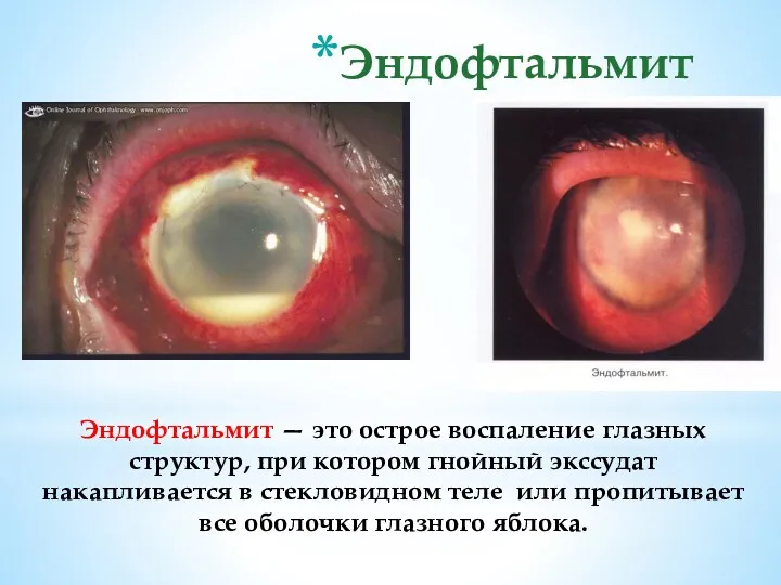 Эндофтальмит Эндофтальмит — это острое воспаление глазных структур, при котором