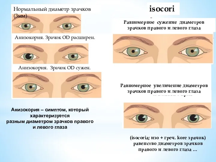 Нормальный диаметр зрачков (3мм) Анизокория. Зрачок OD расширен. Анизокория. Зрачок