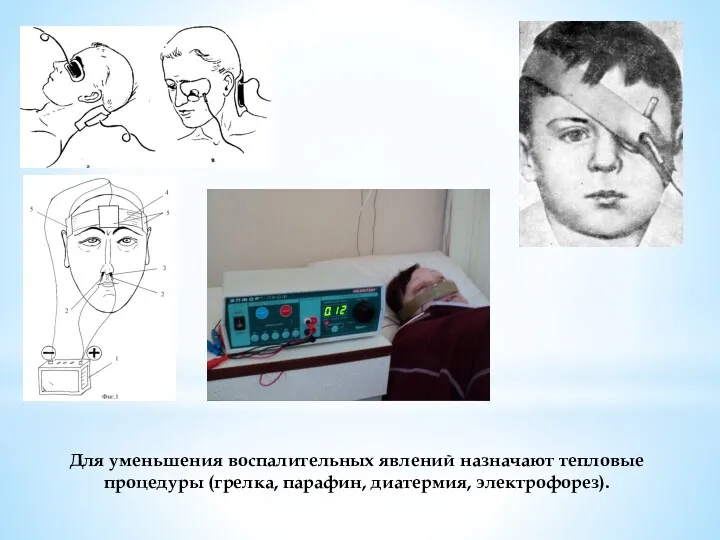 Для уменьшения воспалительных явлений назначают тепловые процедуры (грелка, парафин, диатермия, электрофорез).