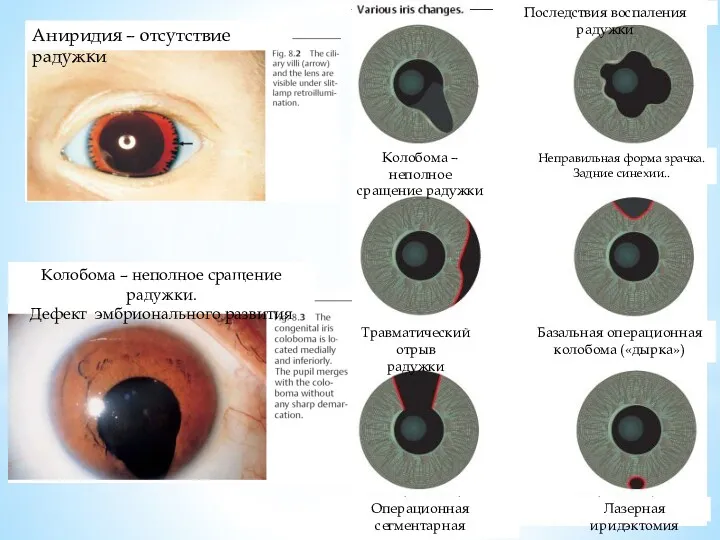 Травматический отрыв радужки Аниридия – отсутствие радужки Колобома – неполное