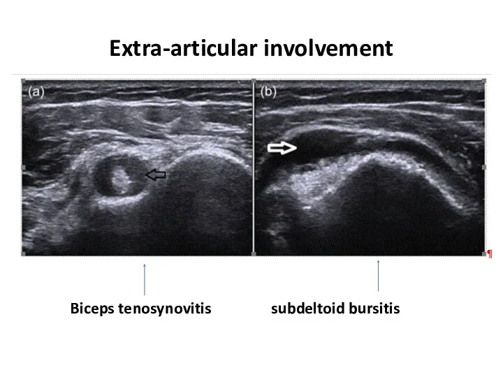 Extra-articular involvement Biceps tenosynovitis subdeltoid bursitis
