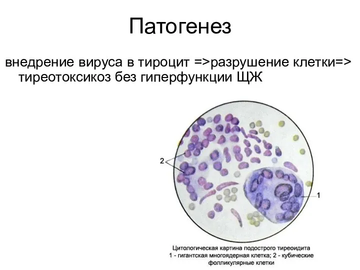 Патогенез внедрение вируса в тироцит =>разрушение клетки=> тиреотоксикоз без гиперфункции ЩЖ