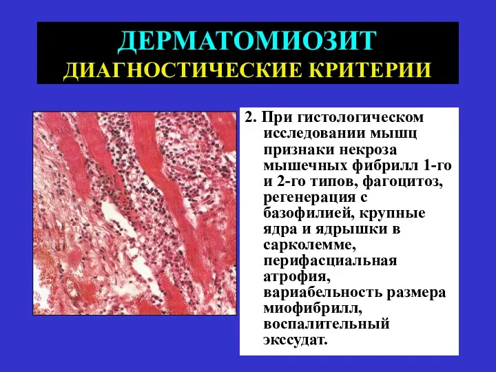 ДЕРМАТОМИОЗИТ ДИАГНОСТИЧЕСКИЕ КРИТЕРИИ 2. При гистологическом исследовании мышц признаки некроза