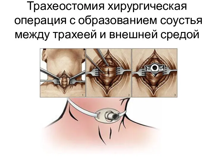 Трахеостомия хирургическая операция с образованием соустья между трахеей и внешней средой