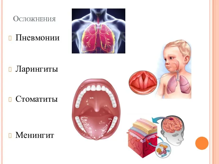 Осложнения Пневмонии Ларингиты Стоматиты Менингит