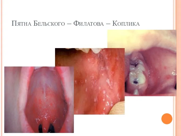 Пятна Бельского – Филатова – Коплика