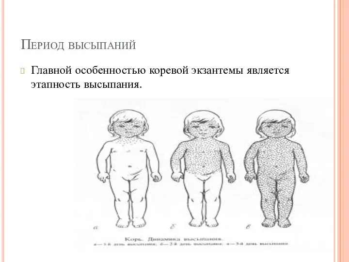 Период высыпаний Главной особенностью коревой экзантемы является этапность высыпания.