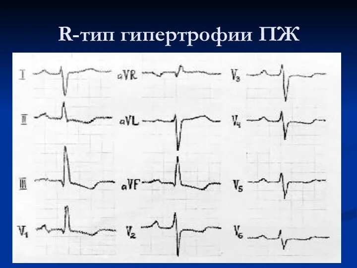 R-тип гипертрофии ПЖ