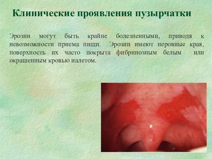Клинические проявления пузырчатки Эрозии могут быть крайне болезненными, приводя к невозможности приема пищи.