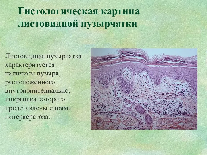 Гистологическая картина листовидной пузырчатки Листовидная пузырчатка характеризуется наличием пузыря, расположенного внутриэпителиально, покрышка которого представлены слоями гиперкератоза.