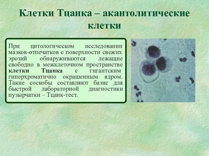 Клетки Тцанка – акантолитические клетки