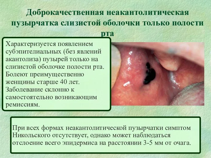Доброкачественная неакантолитическая пузырчатка слизистой оболочки только полости рта