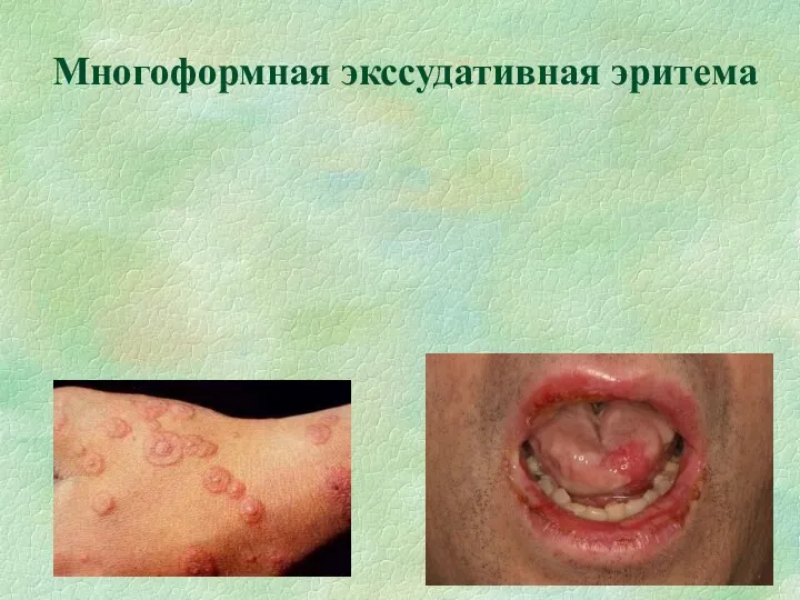 Многоформная экссудативная эритема При изолированном поражении полости рта может быть принята за пузырчатку.
