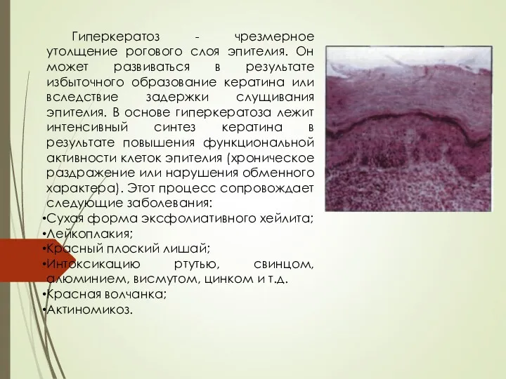 Гиперкератоз - чрезмерное утолщение рогового слоя эпителия. Он может развиваться