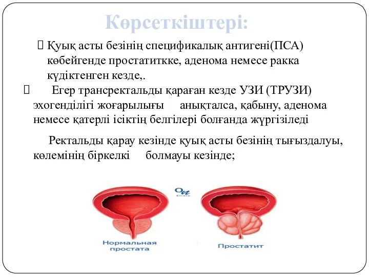 Қуық асты безінің спецификалық антигені(ПСА) көбейгенде простатиткке, аденома немесе ракка