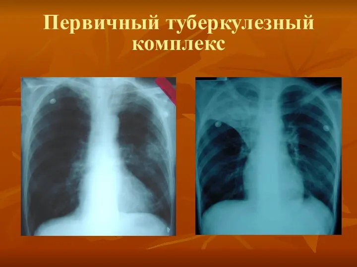 Первичный туберкулезный комплекс
