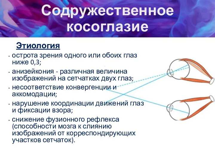 Содружественное косоглазие Этиология острота зрения одного или обоих глаз ниже