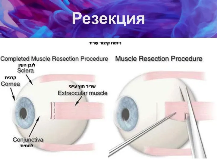 Резекция