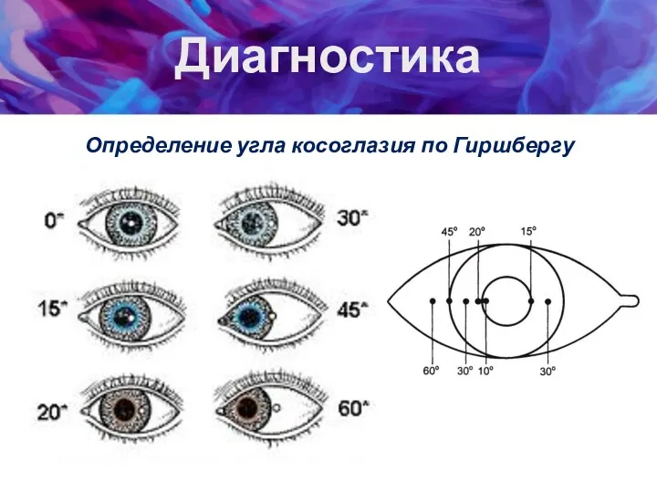 Диагностика Определение угла косоглазия по Гиршбергу