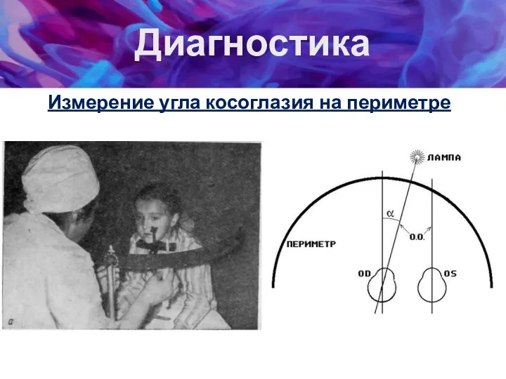 Диагностика Измерение угла косоглазия на периметре