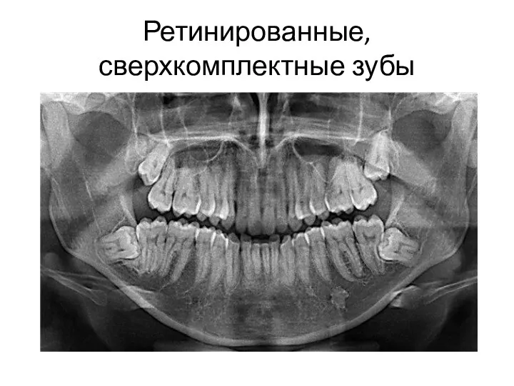 Ретинированные, сверхкомплектные зубы