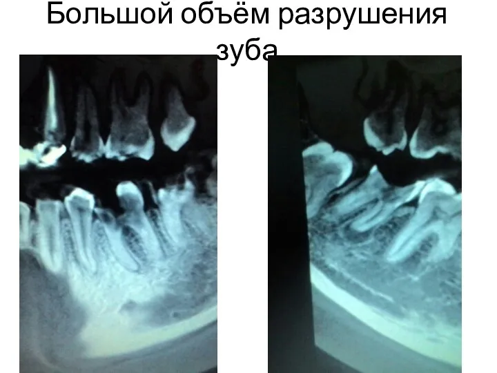 Большой объём разрушения зуба