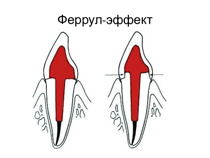 Феррул-эффект