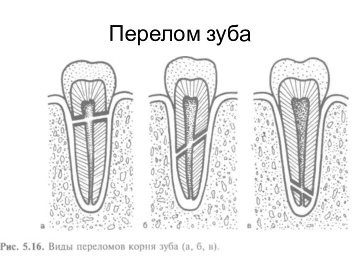 Перелом зуба