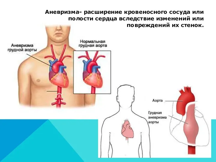Аневризма- расширение кровеносного сосуда или полости сердца вследствие изменений или повреждений их стенок.