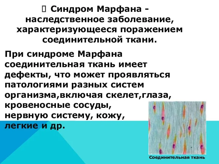 Синдром Марфана -наследственное заболевание, характеризующееся поражением соединительной ткани. При синдроме Марфана соединительная ткань