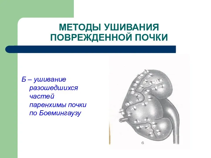 МЕТОДЫ УШИВАНИЯ ПОВРЕЖДЕННОЙ ПОЧКИ Б – ушивание разошедшихся частей паренхимы почки по Боемингаузу