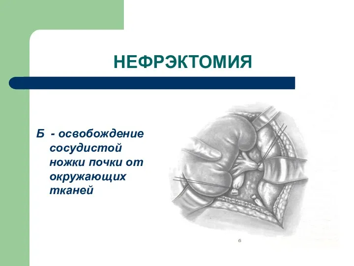 НЕФРЭКТОМИЯ Б - освобождение сосудистой ножки почки от окружающих тканей