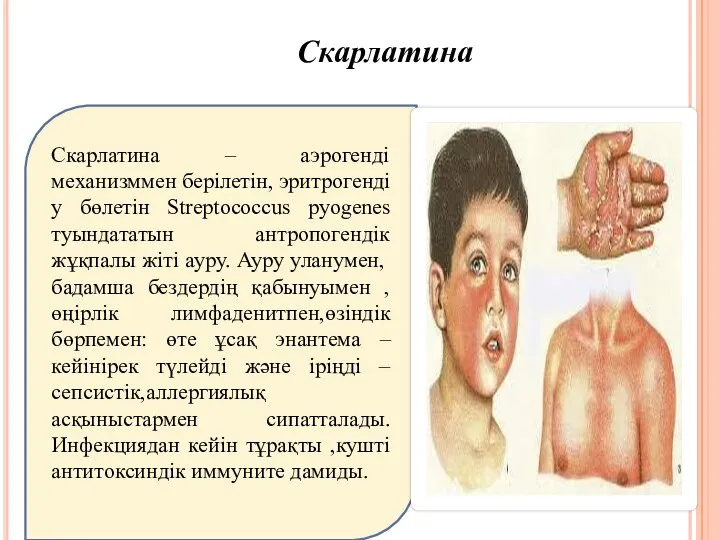 Скарлатина Скарлатина – аэрогенді механизммен берілетін, эритрогенді у бөлетін Streptococcus