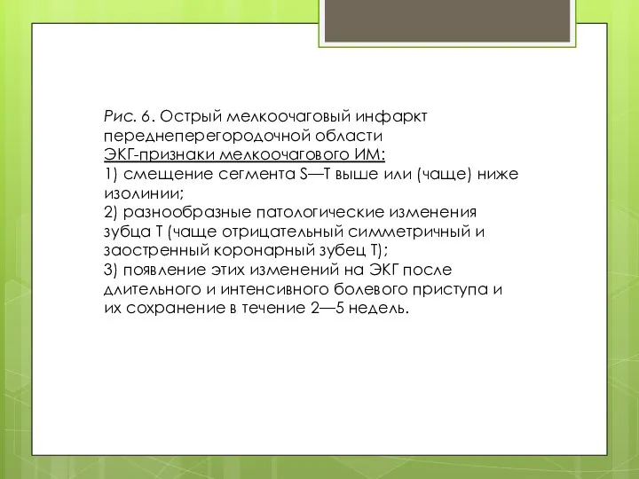 Рис. 6. Острый мелкоочаговый инфаркт переднеперегородочной области ЭКГ-признаки мелкоочагового ИМ: