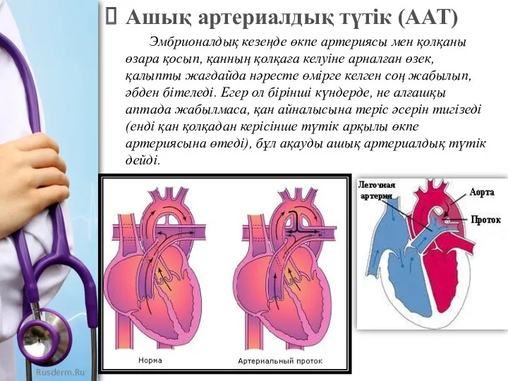 Ашық артериалдық түтік (ААТ) Эмбрионалдық кезеңде өкпе артериясы мен қолқаны