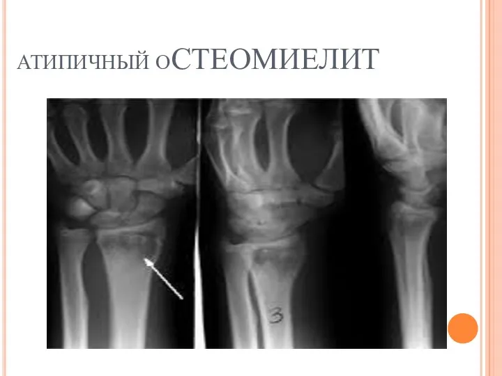 АТИПИЧНЫЙ ОСТЕОМИЕЛИТ