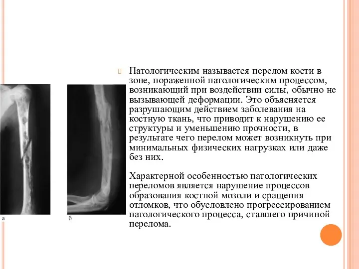 ПАТОЛОГИЧЕСКИЙ ПЕРЕЛОМ Патологическим называется перелом кости в зоне, пораженной патологическим