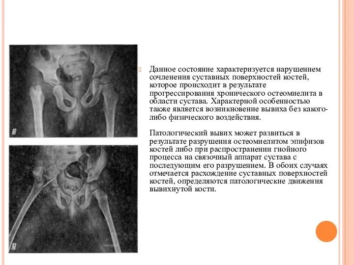 ПАТОЛОГИЧЕСКИЙ ВЫВИХ Данное состояние характеризуется нарушением сочленения суставных поверхностей костей,