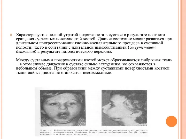 АНКИЛОЗ Характеризуется полной утратой подвижности в суставе в результате плотного