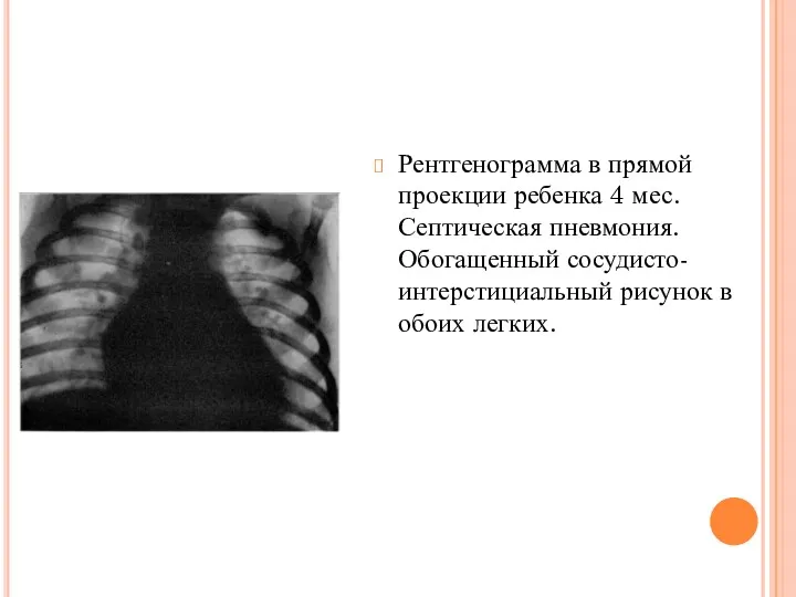 Рентгенограмма в прямой проекции ребенка 4 мес. Септическая пневмония. Обогащенный сосудисто-интерстициальный рисунок в обоих легких.