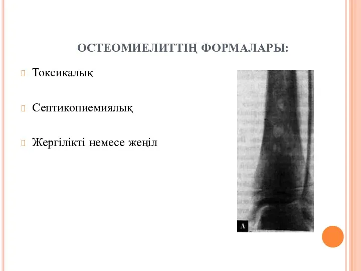 ОСТЕОМИЕЛИТТІҢ ФОРМАЛАРЫ: Токсикалық Септикопиемиялық Жергілікті немесе жеңіл