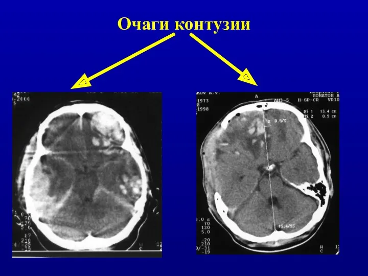 Очаги контузии